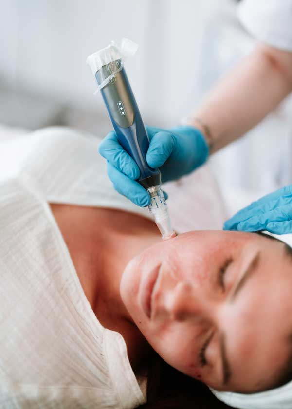 Microneedling_1 Microneedling_1