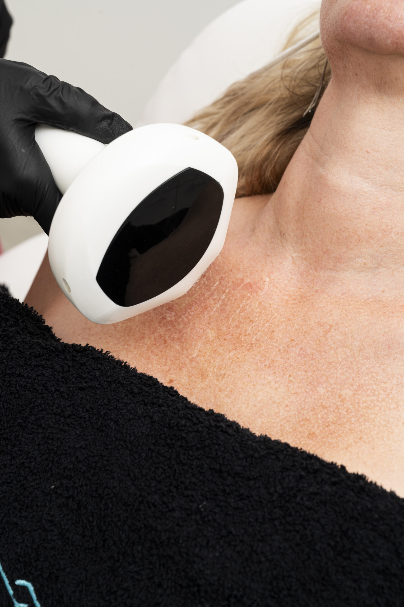 IPL-Laser-Behandlung in Wien IPL-Laser-Behandlung in Wien